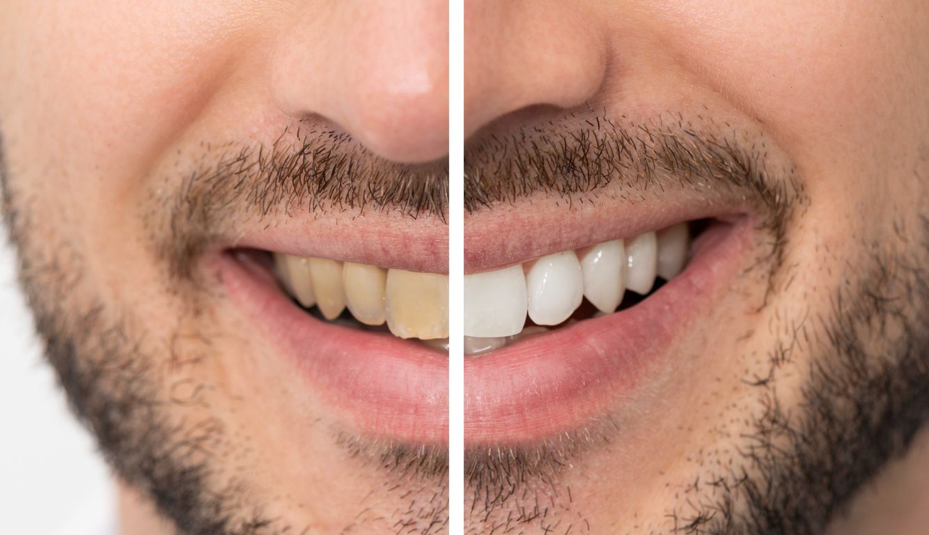 teeth whitening male