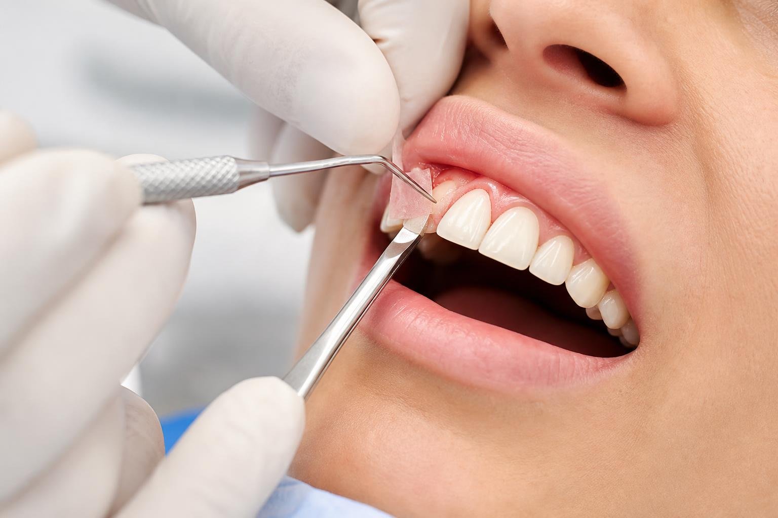 Close-up of a dentist performing a gum grafting procedure on a patient's gums in a dental clinic.
