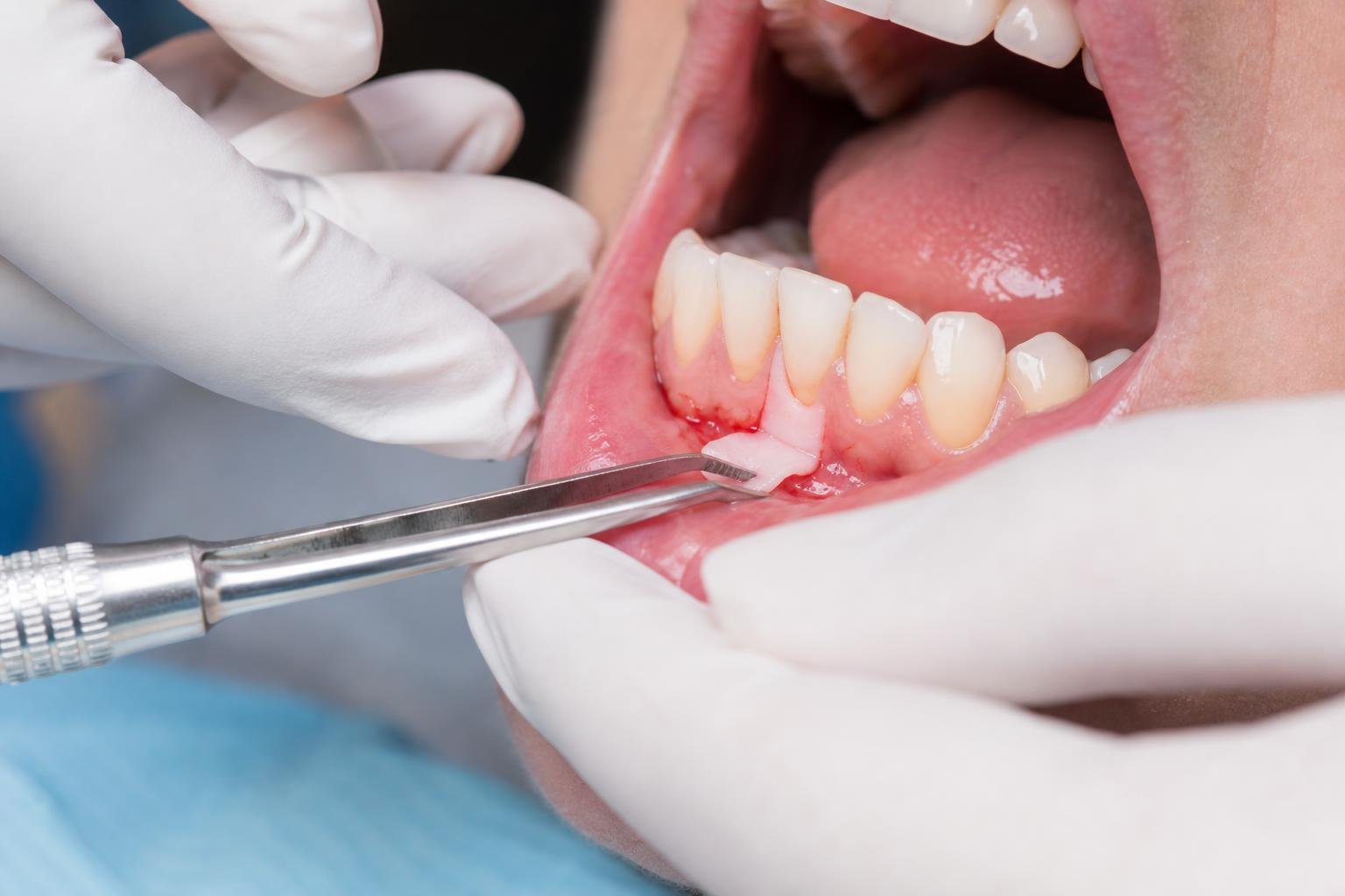 Close-up of a dentist performing gum grafting treatment on a patient's open mouth.