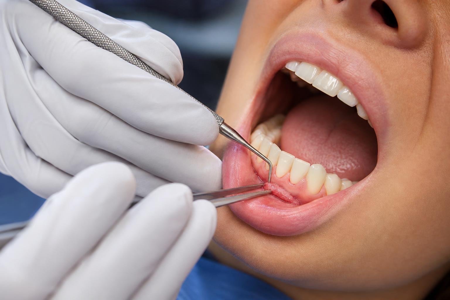 Close-up of a dentist performing a gum grafting procedure inside a patient's open mouth.